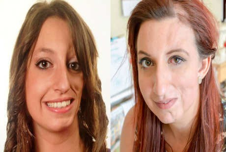 Sakit Langka, Wajah Wanita Ini Bisa Meleleh Jika Dipukul