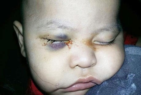 Dokter Keliru Saat Operasi Mata, Bocah Ini Kehilangan Kedua Penglihatan