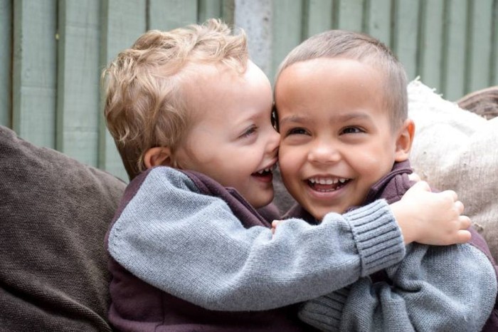 Bobby dan Riley, si Kembar yang Beda Warna Kulit dan Mata