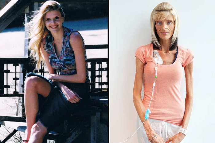 Idap Kondisi Langka, Tubuh Lisa Kurus dan Bobotnya Tak Bisa Bertambah