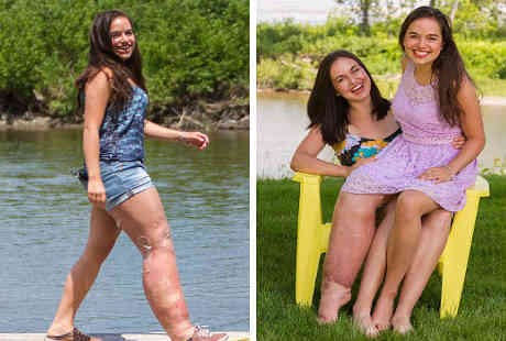 Sindrom Langka, Kaki Kanan Remaja Ini Lebih Besar dari Kaki Kirinya