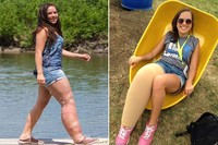 Namun bukannya malu, Isa-Bella tumbuh menjadi remaja yang penuh percaya diri. Tahu dirinya berbeda, ia tak pernah segan untuk menjelaskan tentang kondisinya kepada siapapun yang menanyakannya. Saya tinggal bilang, saya memang terlahir seperti ini, katanya. (Foto: Barcroft/Daily Mail)