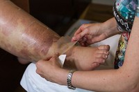 Semacam koyo inilah yang ditempelkan Tardif ke sepanjang kaki kanan Isa-Bella untuk melancarkan aliran limpanyanya kembali. Dan tampaknya terapi ini berhasil, sebab setelah tiga minggu, lebar kaki Isa-Bella berkurang sebanyak 6 cm. Berat kakinya yang dulu mencapai 66 kg, kini tinggal 63 kg. Saya berencana memakainya terus, pungkas Isa-Bella. (Foto: Barcroft/Daily Mail)