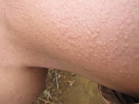 5-10 Menit kemudian, bagian tubuh yang digosok daun gatal akan berwarna merah dan bentol. Bentolnya pun sangat banyak, bukan cuma satu dan dua. Melihat bentolnya, bikin merinding (Afif/detikTravel)