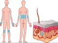 Jangan Jauhi Pengidap Psoriasis