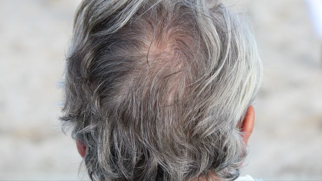 Fakta Ilmiah Stres Ubah Rambut Jadi Uban dalam Semalam