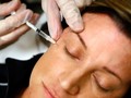 Menimbang Keamanan Injeksi Botox dan Filler untuk AntiAging