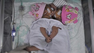 Bayi Kembar Siam Asal Tapanuli Utara Dirawat di Medan
