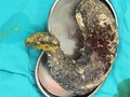 Gumpalan Rambut Seberat Dua Kilogram di Perut Bocah Perempuan