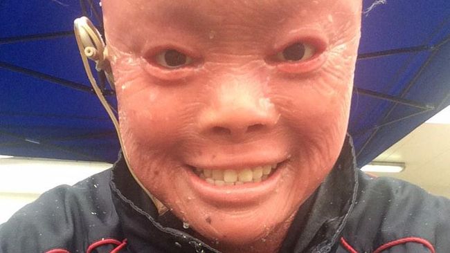 Kisah Mui Thomas, 'Manusia Ikan' dengan Kulit Penuh Sisik