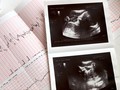 Polusi Udara Bisa Pengaruhi Kematian Bayi dalam Rahim