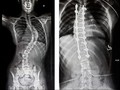 Kenali Tulang Belakang, Cara Mudah Deteksi Skoliosis