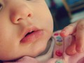 Dermatitis Atopik, Tak Cuma Gara-gara Cubit Pipi Bayi