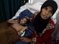 Warga di 404 Daerah di Indonesia Menderita Gizi Akut