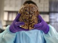 Demensia Alzheimer, Kerusakan dan Kematian Fungsi Otak
