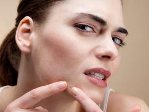 Bikin Gemas, Ada Produk Mainan Pencet Jerawat Bikin Gemas, Ada Produk Mainan Pencet Jerawat