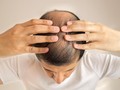 Generasi Millennial Rentan Alami Kerontokan Rambut