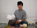 'Manusia Pohon' Bangladesh Kembali 'Memiliki' Tangan