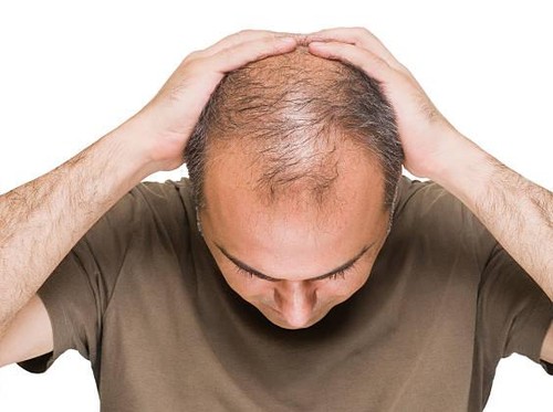 Kebotakan Bikin Stres? Ini Tips Cerdas Memilih Produk Penumbuh Rambut Kebotakan Bikin Stres? Ini Tips Cerdas Memilih Produk Penumbuh Rambut