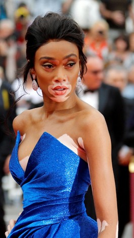 Foto: Model Berkulit Belang Curi Perhatian di Red Carpet Cannes Foto: Model Berkulit Belang Curi Perhatian di Red Carpet Cannes