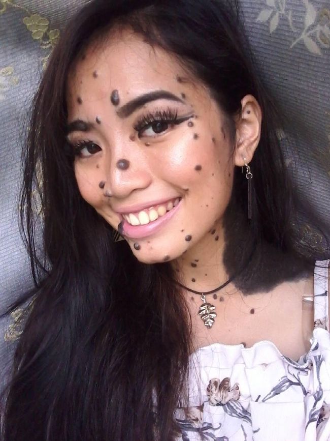 Foto penyakit kulit langka 79 Foto penyakit kulit langka 47