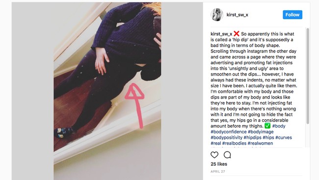 Lagi Ngetren, Tetap Bangga Walau Pinggul Tak Sesempurna 