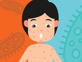 Kenali Bahaya dan Pencegahan Campak dan Rubella