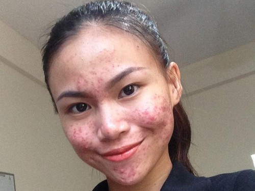 Bangga Pamer Foto Penuh Jerawat, Wanita Ini Ubah Persepsi tentang Cantik Bangga Pamer Foto Penuh Jerawat, Wanita Ini Ubah Persepsi tentang Cantik