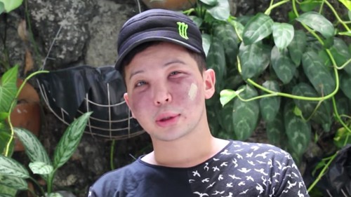 Pipi Pria Ini Bernanah dan Membusuk Pascasuntik Filler Oleh Dokter Palsu Pipi Pria Ini Bernanah dan Membusuk Pascasuntik Filler Oleh Dokter Palsu
