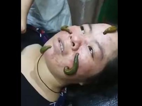 Benarkah Jerawat Bisa Sembuh dengan Facial Lintah? Ini Kata Dokter Kulit Benarkah Jerawat Bisa Sembuh dengan Facial Lintah? Ini Kata Dokter Kulit