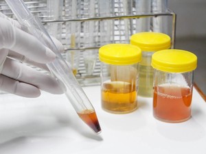 Ini 7 Warna Urine dan Indikator Kesehatannya, Kamu Termasuk yang Mana?