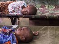 FOTO: Gizi Buruk di Tanah Asmat