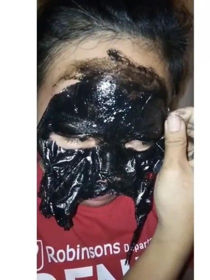 Pakai Masker Peel Off, Alis Wanita Ini Ikut Tercabut Hingga Hampir Botak Pakai Masker Peel Off, Alis Wanita Ini Ikut Tercabut Hingga Hampir Botak