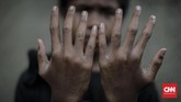 Salah satunya dialami oleh remaja Ganjar asal Majalaya yang berusia 13 tahun. Dia menyatakan pada Sabtu (31/3) dirinya menderita penyakit kulit karena menggunakan air Sungai Citarum yang sudah terkontaminas. (CNNIndonesia/Adhi Wicaksono).