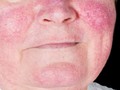 Faktor Hormonal Buat Lupus Lebih Berisiko pada Wanita