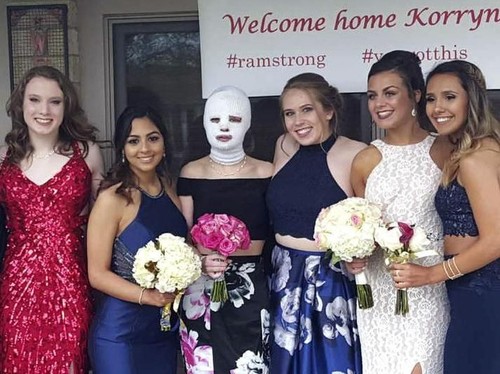 Gadis Ini Jadi Korban Luka Bakar, Ini yang Dilakukan Teman-temannya Gadis Ini Jadi Korban Luka Bakar, Ini yang Dilakukan Teman-temannya