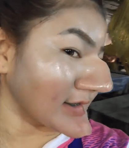 Wanita Ngaku Oplas Hidung Mirip Nenek Sihir, Fakta Sebenarnya Terungkap Wanita Ngaku Oplas Hidung Mirip Nenek Sihir, Fakta Sebenarnya Terungkap