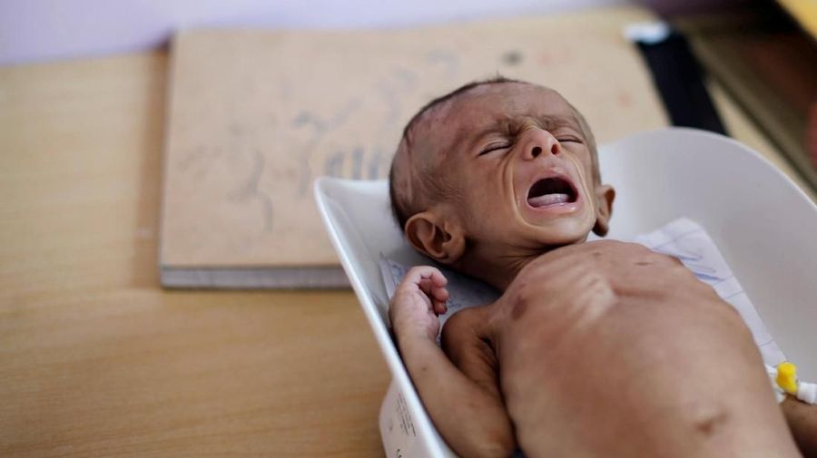 Diperkirakan 1,8 juta anak-anak kekurangan gizi di negara ini akibat konflik dalam tiga tahun ini.