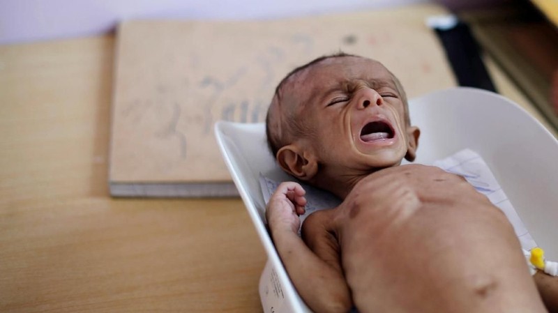 Diperkirakan 1,8 juta anak-anak kekurangan gizi di negara ini akibat konflik dalam tiga tahun ini.