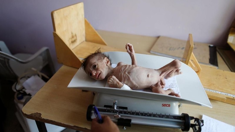 Diperkirakan 1,8 juta anak-anak kekurangan gizi di negara ini akibat konflik dalam tiga tahun ini.