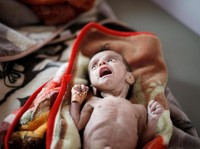 Yaman Dilanda Perang, Anak-anak Menderita Gizi Buruk