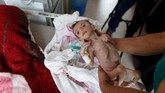 Ratusan anak di negara miskin itu kini tengah diserang penyakit gizi buruk yang parah. (REUTERS/Khaled Abdullah)