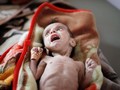 FOTO: Kisah Pilu Anak-anak Yaman Malnutrisi Korban Perang
