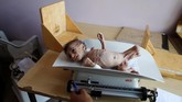 UNICEF mengaku kini tengah mengobati sekitar 224 ribu pada balita di bawah 5 tahun yang terkena malnutrisi dengan pengobatan terapeutik sejak awal 2018. (REUTERS/Khaled Abdullah)