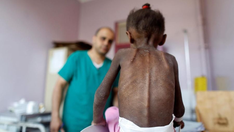 A nurse looks as he weighs a malnourished girl at a malnutrition treatment center in Sanaa, Yemen October 7, 2018. Picture taken October 7, 2018. REUTERS/Khaled Abdullah