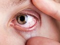 Sindrom Sjogren, Saat Mata Seperti 'Terbakar'