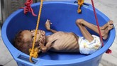 Bassem Mohamed Hassan, bayi Yaman berusia dua tahun yang mengalami malnutrisi, sedang ditimbang di rumah sakit di Abs, Hajjah, pada 19 September 2018. (Essa Ahmed / AFP)
