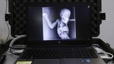 Foto X-Ray Brenda yang menunjukkan luka tembakannya. (AP Photo/Binsar Bakkara)