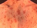 VIDEO: Wabah Campak Hantui AS