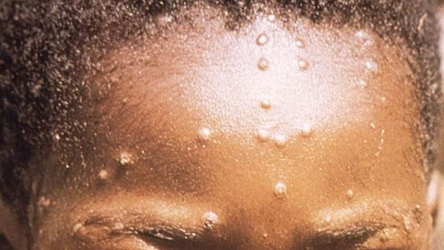 Monkeypox (CDC Public Health Image Library)